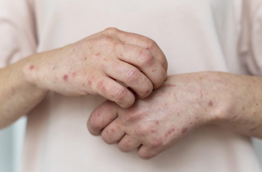  Especialista infectologista alerta para aumento dos casos de sífilis e reforça importância da prevenção